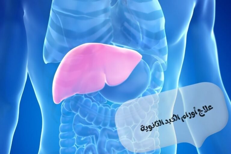 علاج اورام الكبد الثانوية